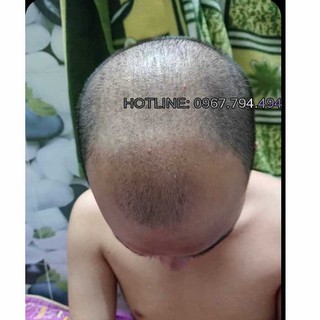 Thuốc mọc tóc Morr F5 ( Minoxidil 5% + Finasteride )