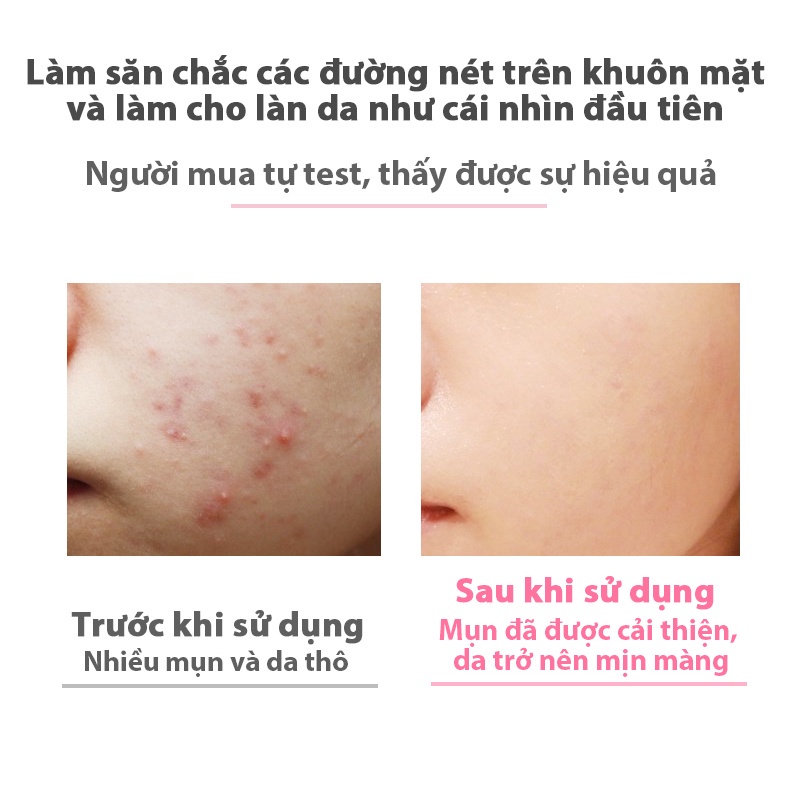 Ánh sáng xanh-đỏ dùng cho vùng mặt giúp cải thiện nếp nhăn vùng rãnh mũi má và nâng cơ-YA29