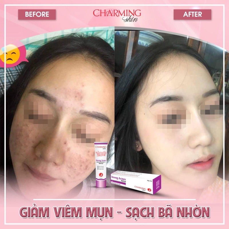 [ TẾT RẺ VÔ ĐỊCH] Kem ngừa mụn Strong Acnes - Charming Skin | BigBuy360 - bigbuy360.vn
