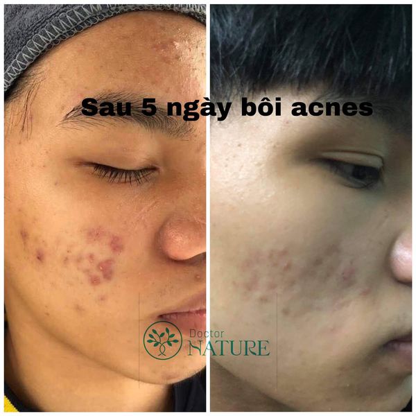 SERUM MỤN ACNES DOCTOR NATUR -