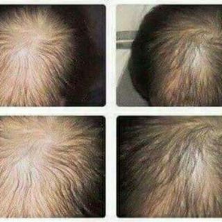 Tinh dầu mọc tóc Hair 100 ml