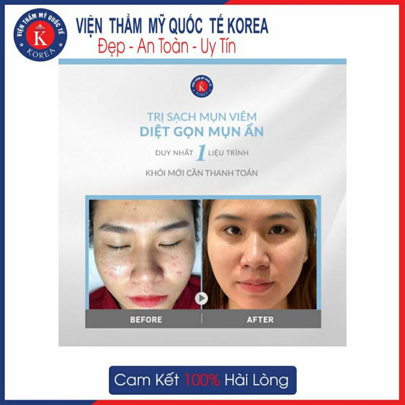 HN[Voucher] - Điều trị mụn chuyên sâu tại Viện Thẩm Mỹ Quốc Tế Korea