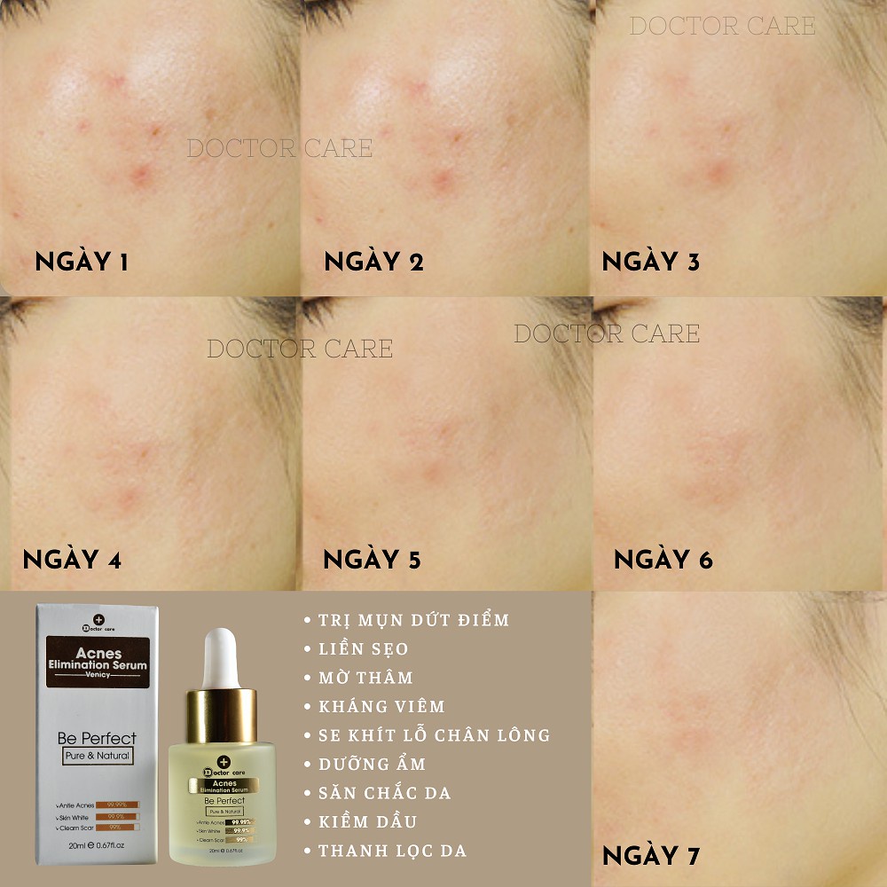 Serum TRI MUN TRANG DA  DOCTOR CARE  Serum tri mun ẩn , mụn đầu đen , mụn thâm , mụn bọc cho da dầu