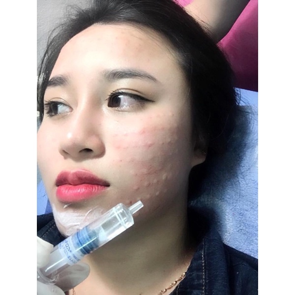 Khoáng HA cấy căng bóng da Nhật kèm đầu kim meso (ảnh thật chủ shop cấy)
