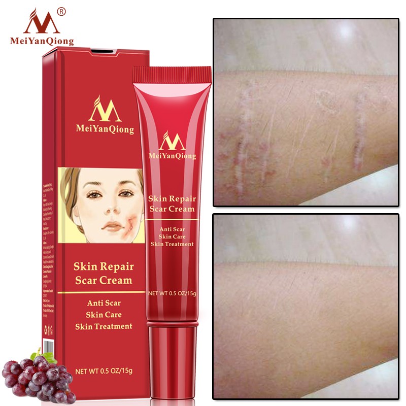 MeiYanQiong Acne Scar Removal Cream Skin Repair Stretch Marks giảm sẹo lồi, lõm, sẹo thâm, do mụn giúp phục hồi các tổn thương trên da thúc đẩy tái tạo da 15ml