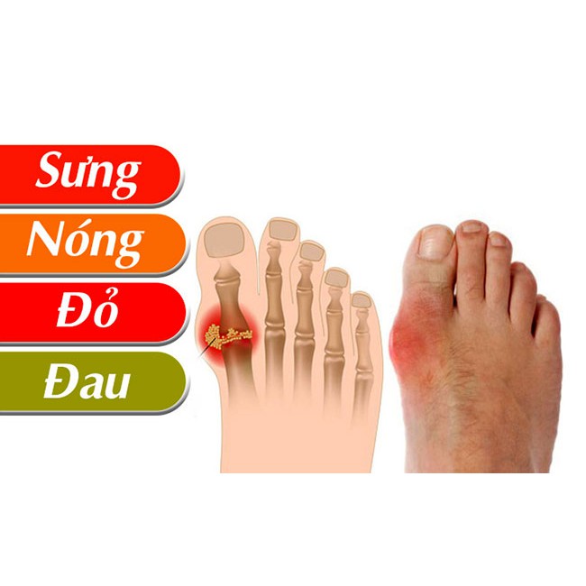 GUTTAN - xua tan nỗi lo bệnh Gout (Gút)