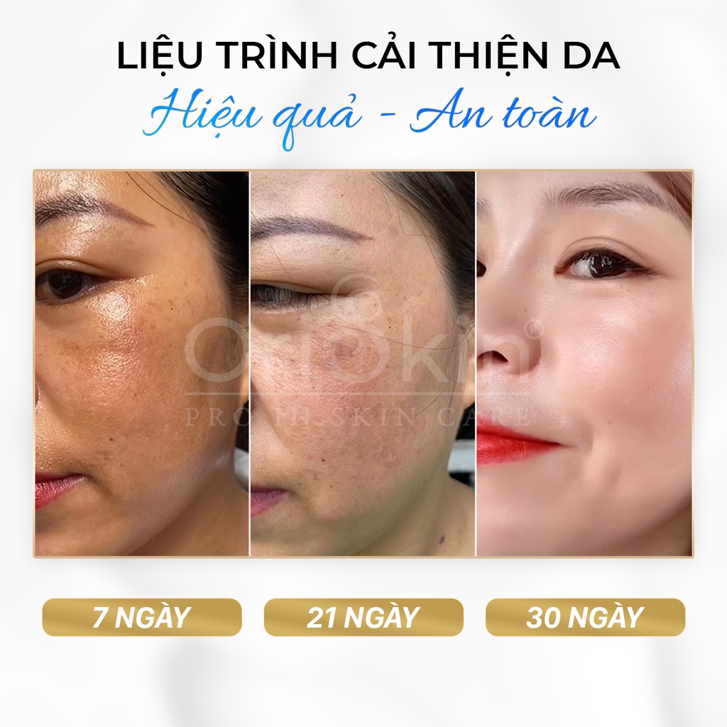 Kem Mờ Nám Tàn Nhang, Dưỡng Trắng Mờ Thâm Dành Cho Cả Da Nhạy Cảm Melasma White Perfect Cream 30g