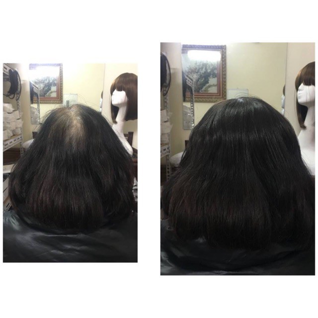 Tóc giả che hói đỉnh đầu- mẫu có đưỡng rãnh da đầu