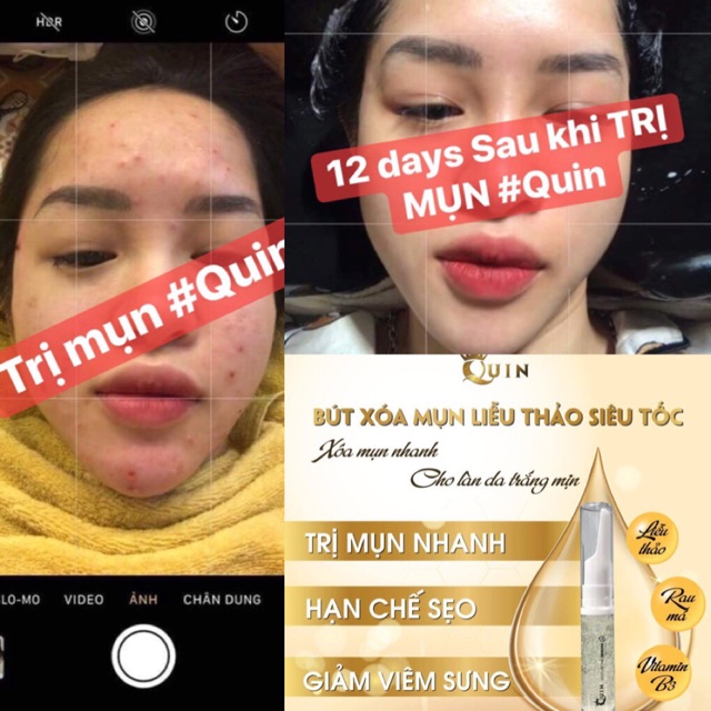 [ BÚT THẦN XOÁ MỤN Thương hiệu CAO CẤP QUIN]