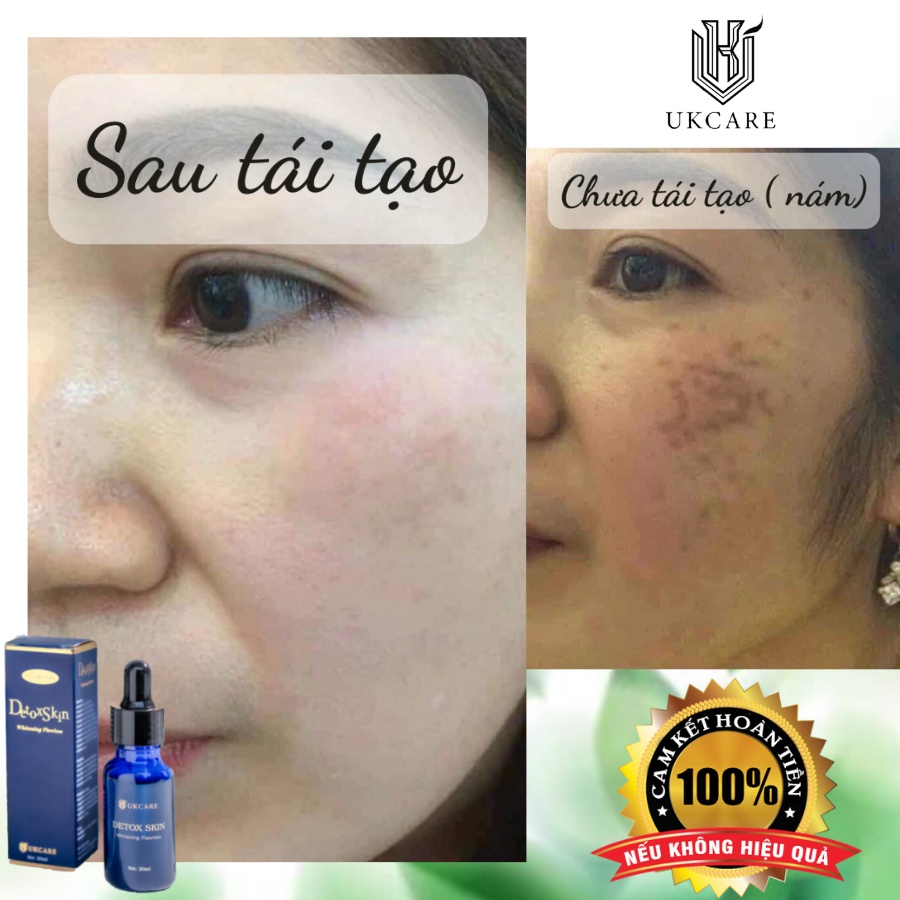 DETOX SKIN – SẠCH MỤN, SẠCH KHUẨN UKCARE | BigBuy360 - bigbuy360.vn