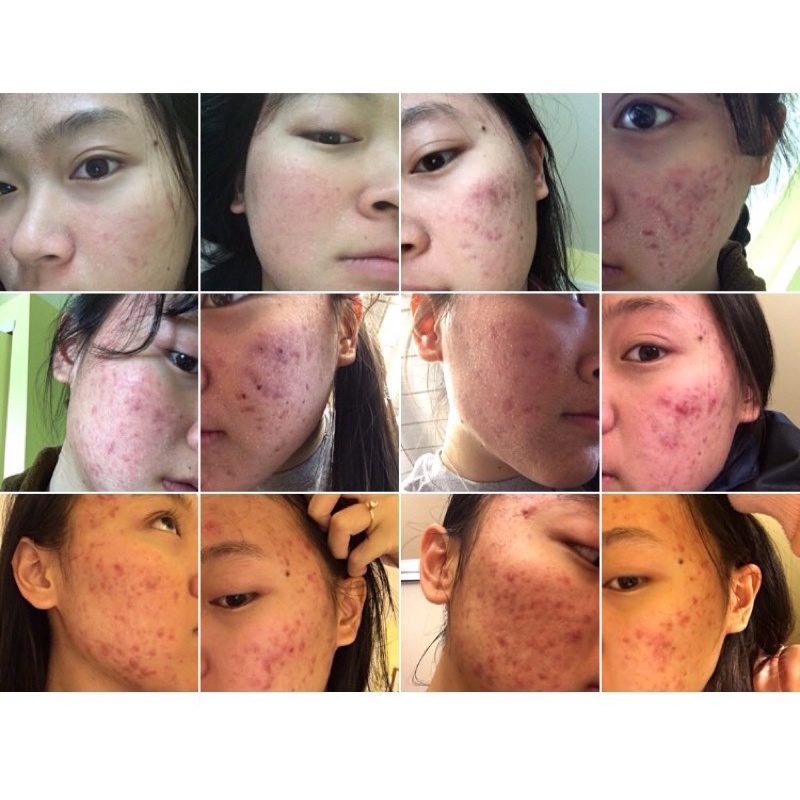 Serum thảo dược mụn may new tái tạo da