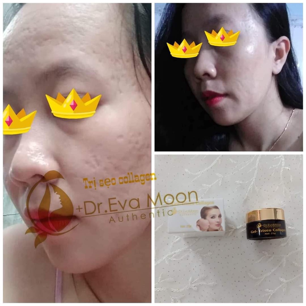 Kem Sẹo, Kem Sẹo Thâm, Rỗ Collagen Dr.EvaMoon CHÍNH HÃNG