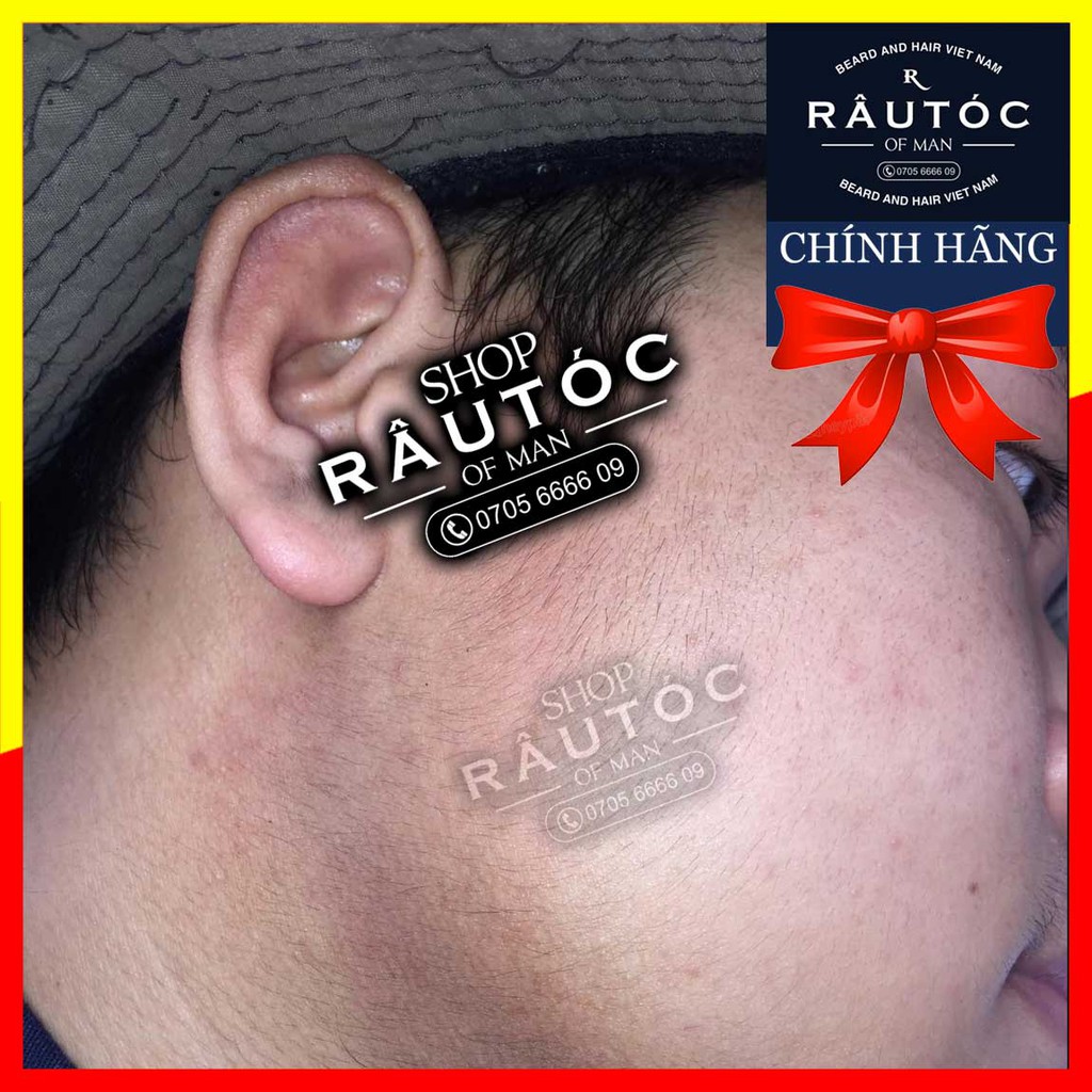 Thuốc mọc râu Minoxidil 5% dạng Foam