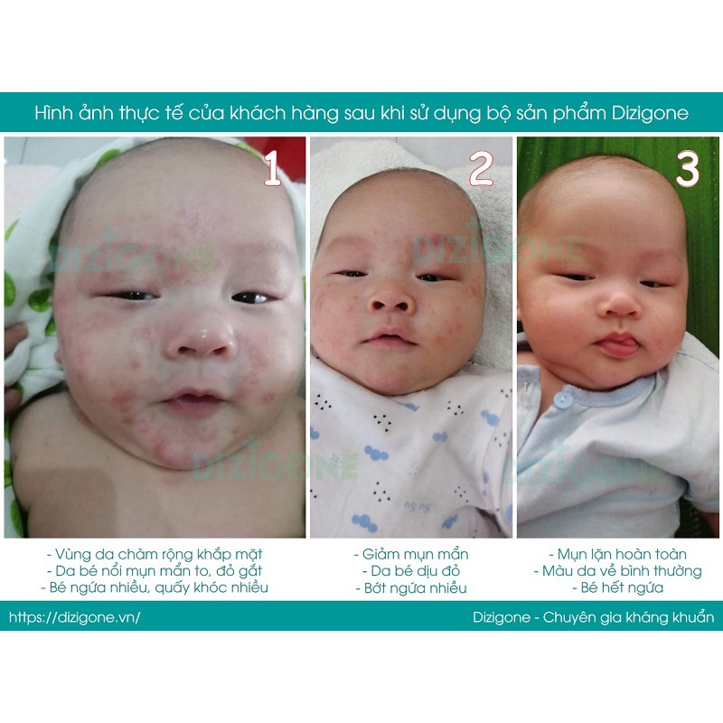 Kem DIZIGONE Baby - Dịu mẩn ngứa, ngừa hăm da, bảo vệ và phục hồi da bé