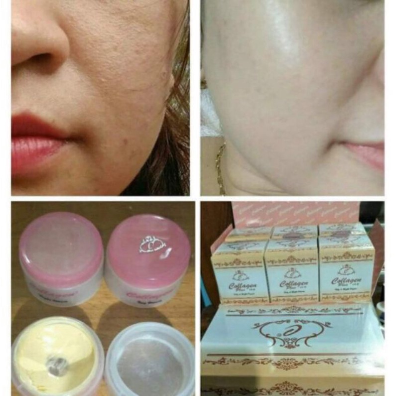 Bộ kem nám tàn nhang collagen plus vit E CHÍNH HÃNG