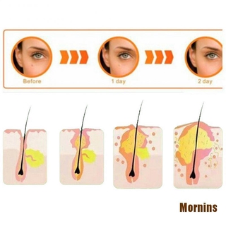 Ms❀Set 36 Miếng Dán Mụn Hydrocolloid Và Mụn Thịt Tiện Dụng