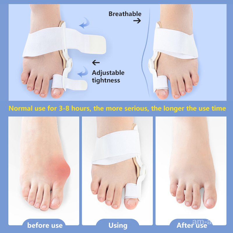 Dụng cụ chỉnh hình duỗi thẳng ngón chân cái dành cho người bị chứng biến dạng ngón chân