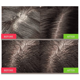 Dầu gội hạn chế gàu Teotema Dandruff Specific Bath