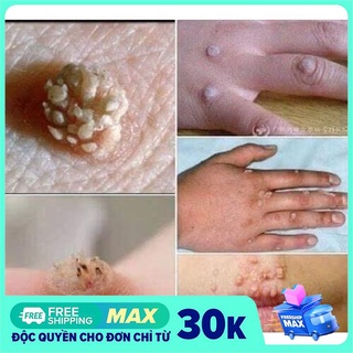 kem xóa nốt ruồi, mụn cóc, mụn thịt, tàn nhang, sẹo lồi Develinil của Nga, cam kết hàng chính hãng, hiệu quả cao