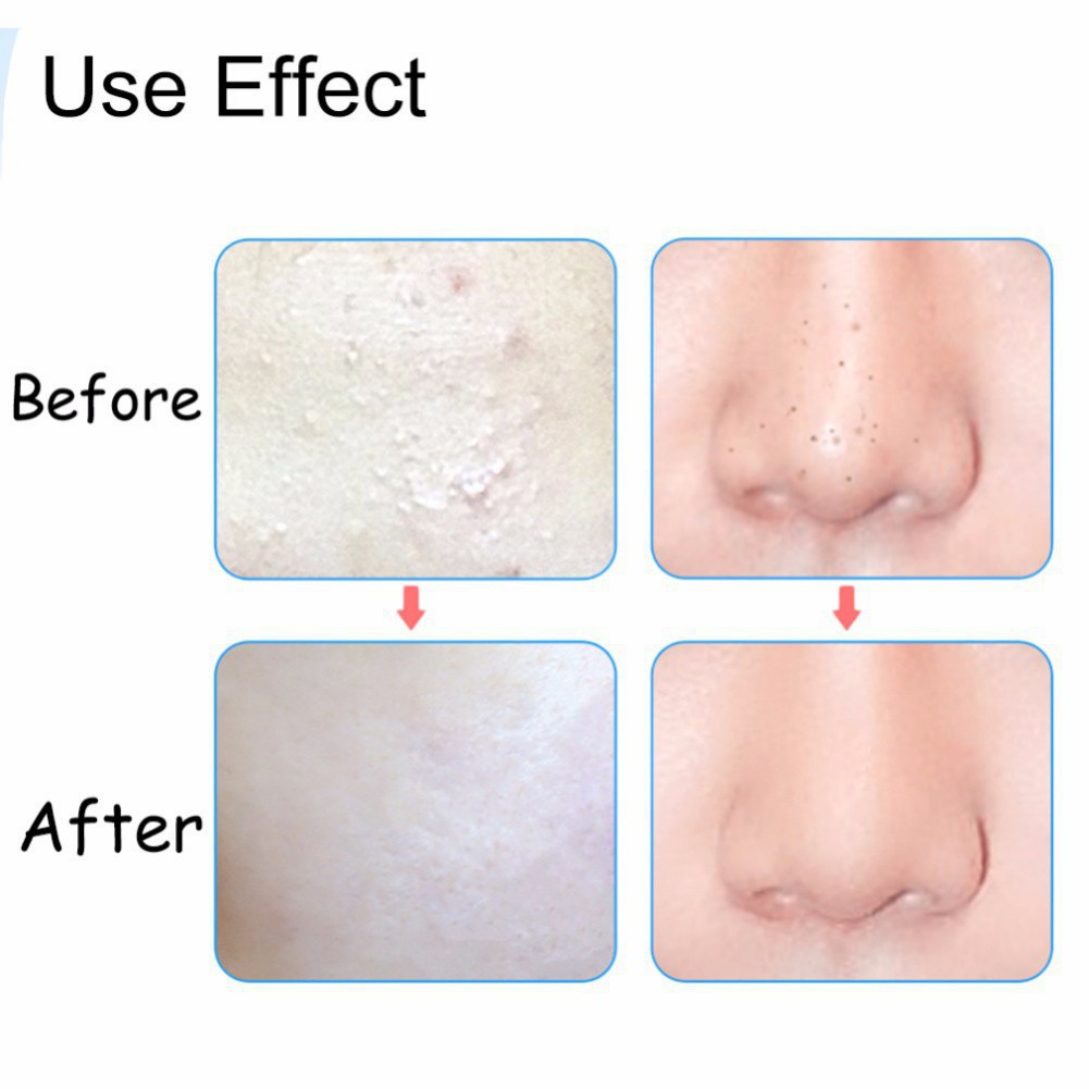 Nhíp gấp mụn đầu dạng móc loại bỏ mụn đầu đen tiện dụng