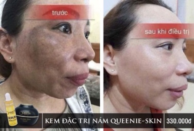 [TẶNG KÈM SERUM] KEM FACE NÁM TÀN NHANG QUEENIE SKIN | BigBuy360 - bigbuy360.vn
