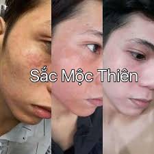 [Giá sỉ] 1 chai tinh chất giúp Tái Tạo Da SẮC MỘC THIÊN Siêu Tốc - Kết Tinh Của Tri Thức, Mụn Rời Xa 100%, Thâm Nám Giảm