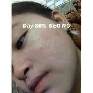 PEEL TCA USA CHẤM SEO THAM NAM DOI MOI