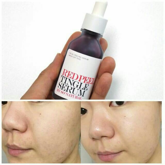 Serum Tái Tạo Da So’Natural Red Peel Tingle Serum