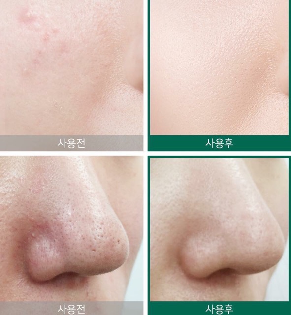 Nước hoa hồng da mụn AHA-BHA-PHA 30 Days Miracle Toner Some By Mi | BigBuy360 - bigbuy360.vn