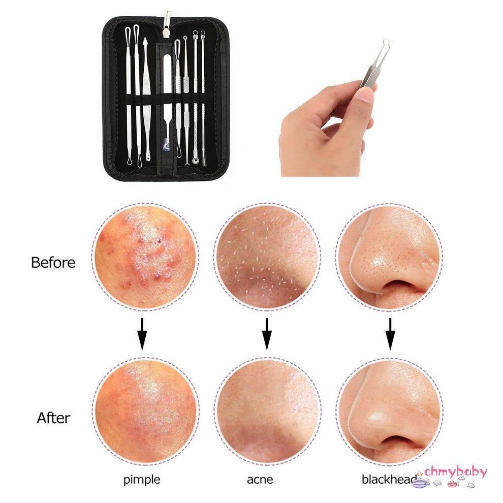Bộ dụng cụ lột mụn đầu đen 8 cái Bộ dụng cụ nặn mụn Kim châm mụn đầu đen [8/17]