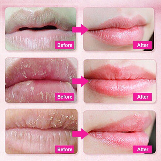 (Hàng Mới Về) Mặt Nạ Môi Collagen Giúp Dưỡng Ẩm Và Làm Mờ Nếp Nhăn Cao Cấp | BigBuy360 - bigbuy360.vn