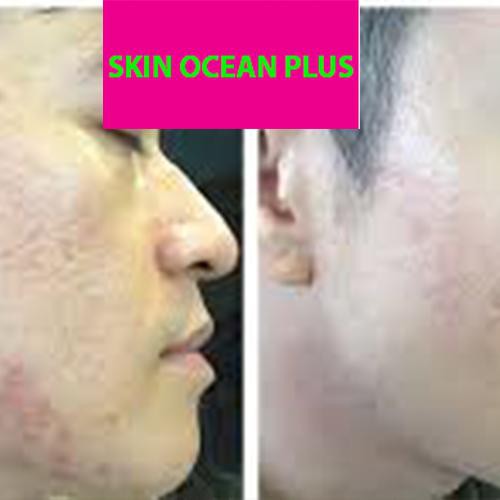 KEM TRỊ MỤN SKIN OCEAN PLUS - TRỊ MỤN TẬN GỐC , HIỆU QUẢ 99% -  NGĂN NGỪA TÁI PHÁT | BigBuy360 - bigbuy360.vn