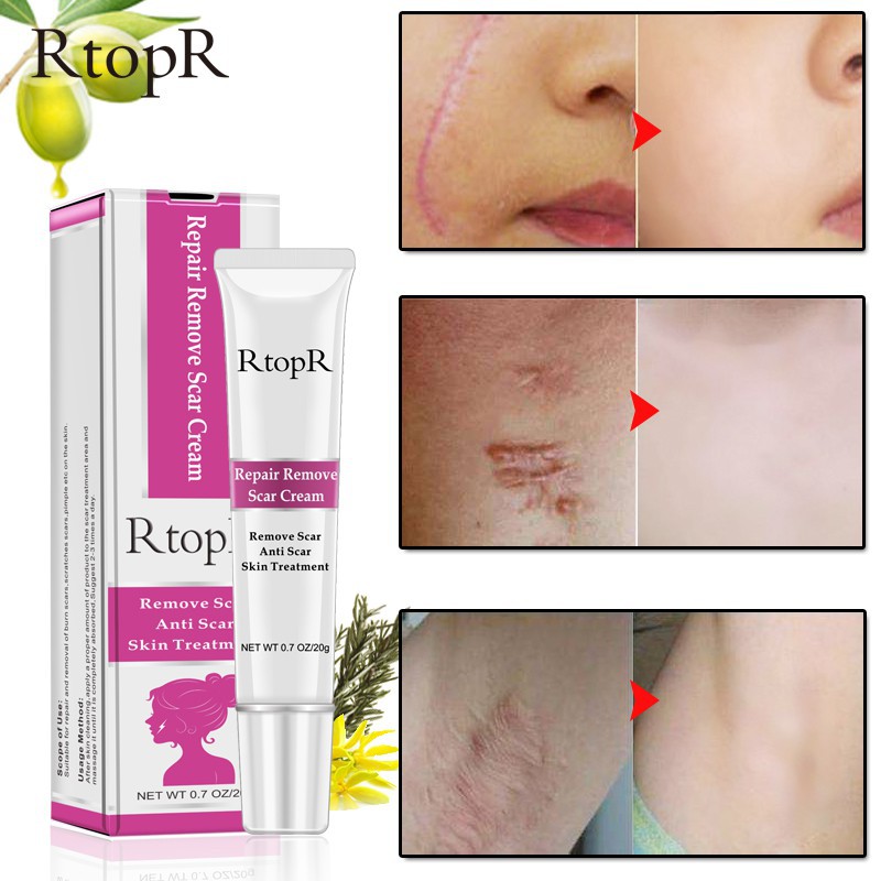 [Hàng mới về] Kem làm mờ và xóa sẹo hiệu quả tiện dụng