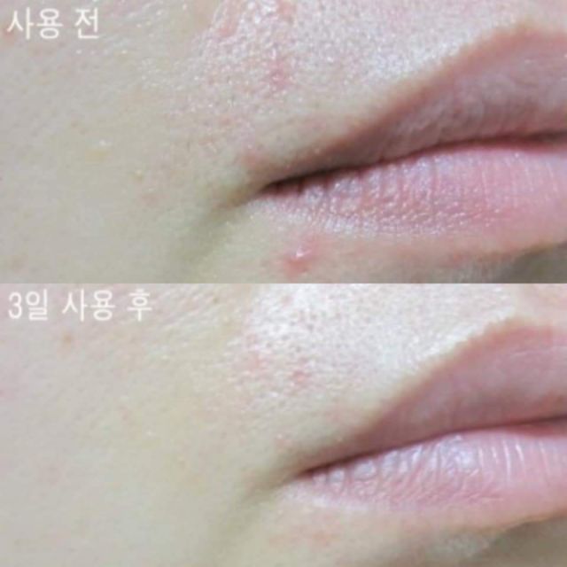 Gel chấm mụn Hanyul