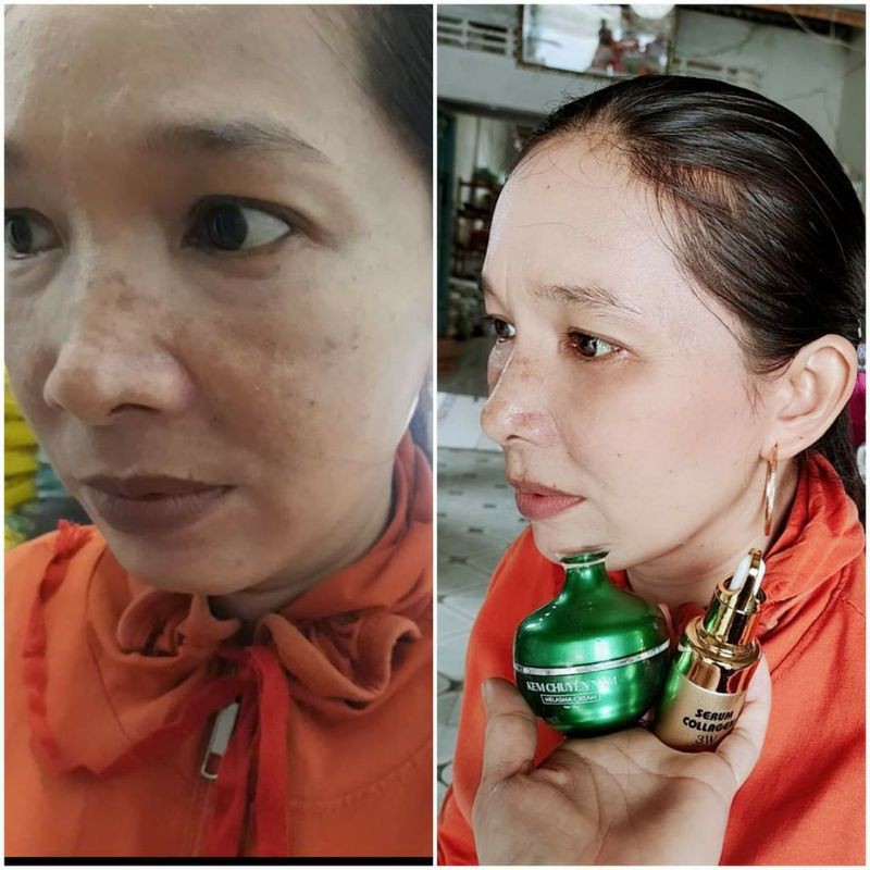 KEM NÁM HUỲNH ĐỖ | BigBuy360 - bigbuy360.vn