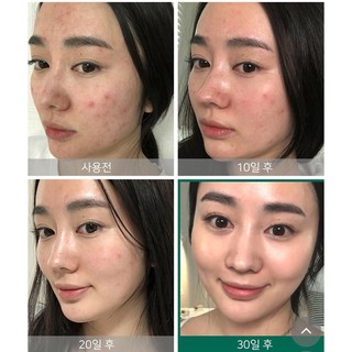 Toner AHA – BHA – PHA 30 Days Miracle Toner