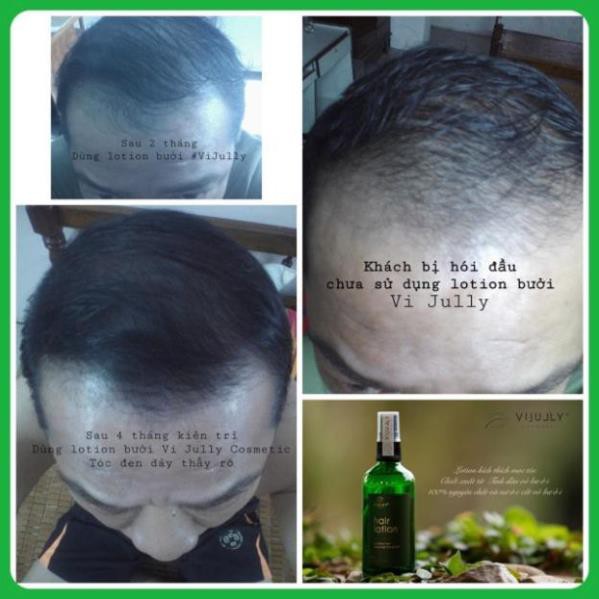 [GIẢM RỤNG 100%] Tinh Dầu Bưởi KÍCH THÍCH MỌC TÓC Vi Jully - Giảm Rụng Tóc - Kích Thích Mọc Tóc - Làm Dài Tóc | BigBuy360 - bigbuy360.vn