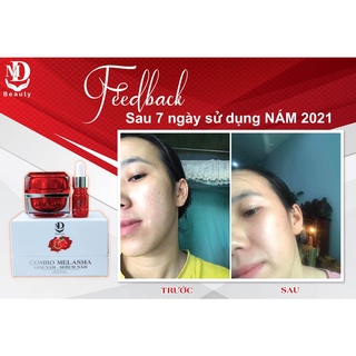 Kem Face Nám Lựu Đỏ MD Beauty