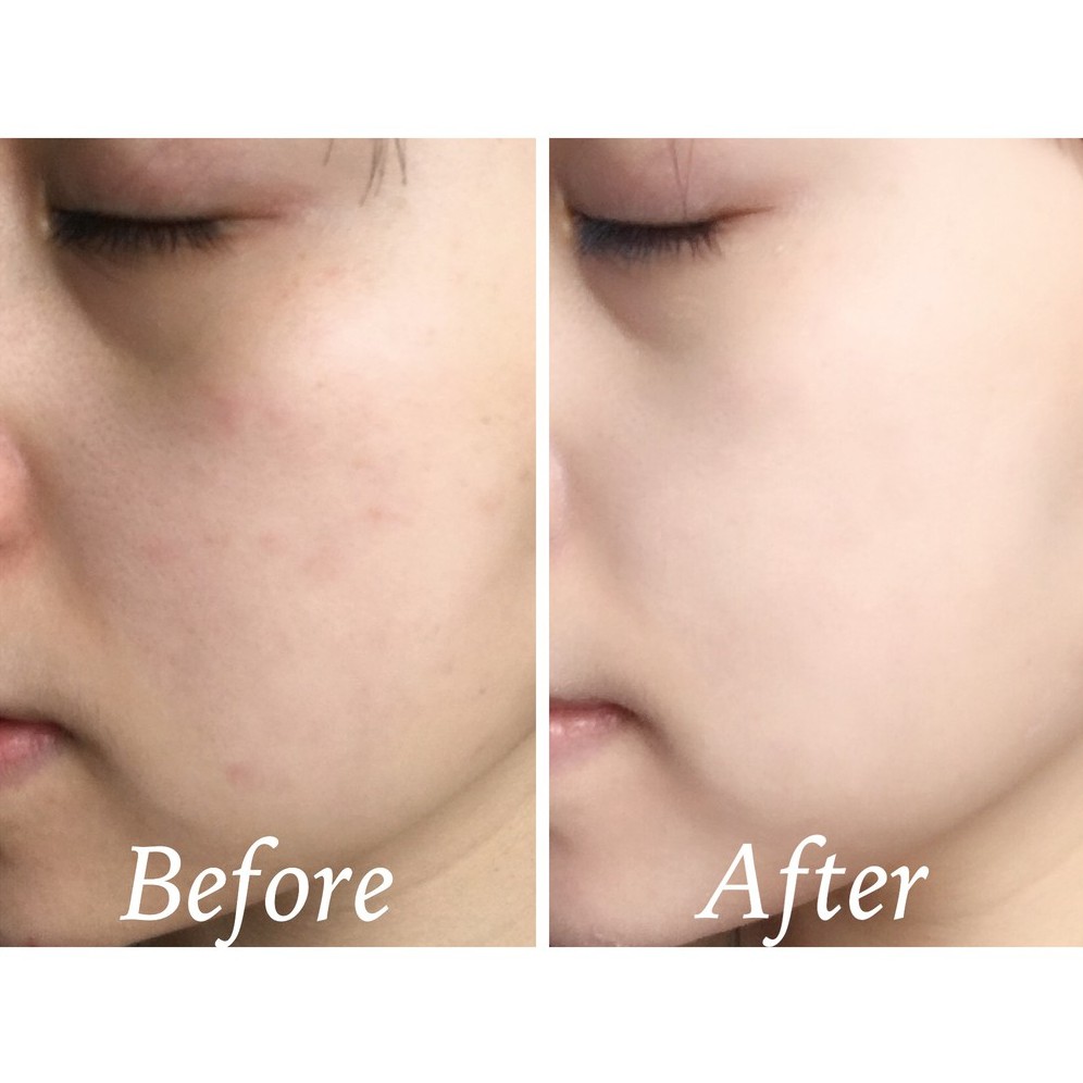 Tinh Chất Tái Tạo Da So'Natural Red Peel Tingle Serum