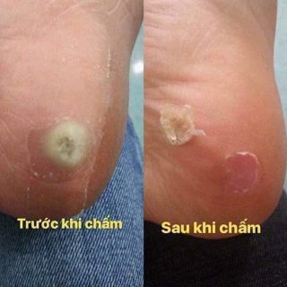 Trị mụn cóc mụn cơm
