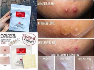 Miếng dán hút mụn Cosrx