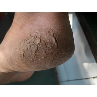 Thảo Dược Bôi Hết Bay Nứt Nẻ, Lột, Bong, Sừng, Mảng Gót Chân(Đông Y Cổ Truyền)