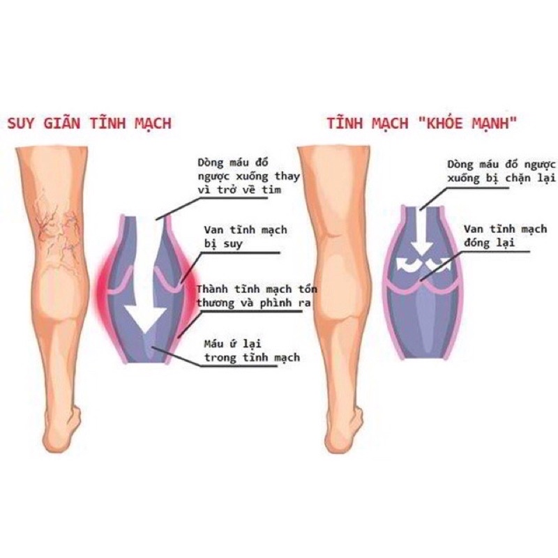 Bộ Viên uống , bôi giãn tĩnh mạch Abtei Venen Aktiv 125ML