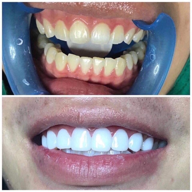 Dán sứ răng Ultra Diamond