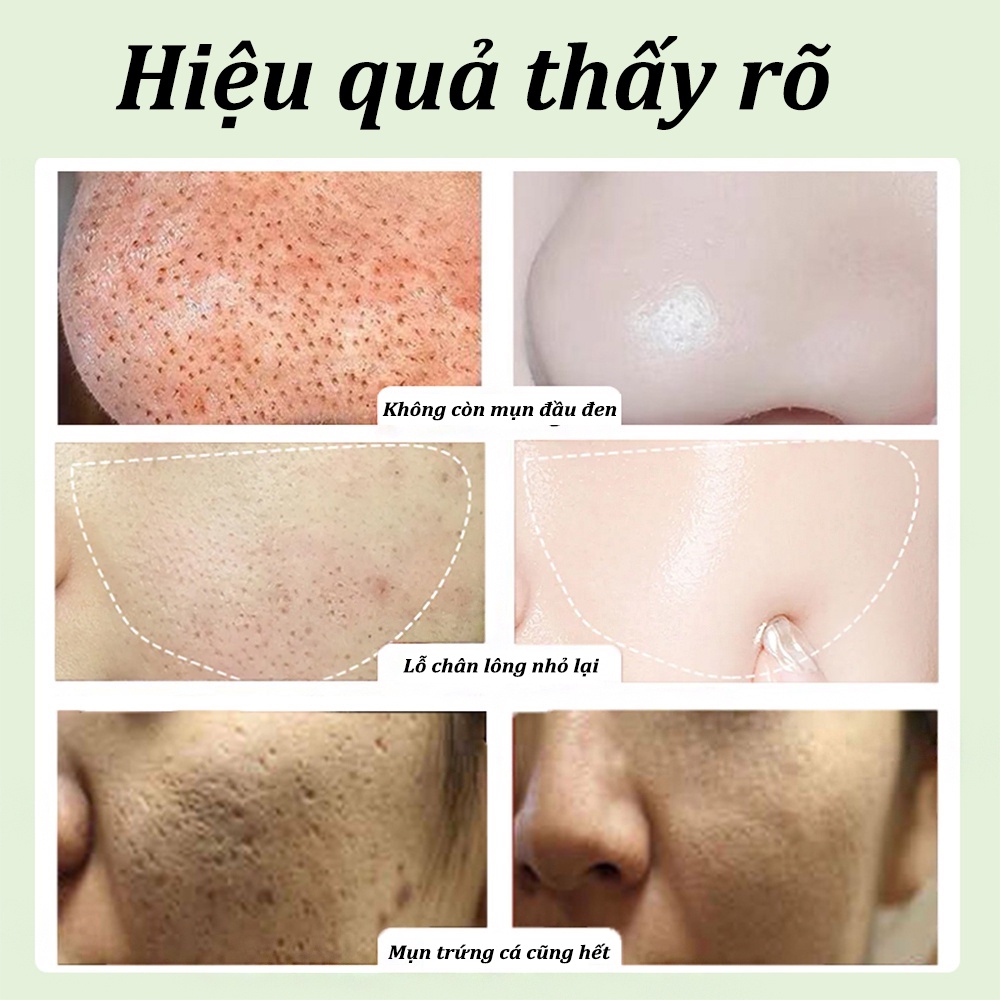 Sữa rửa mặt lành mụn Sữa rửa mặt trắng da Gel rửa mặt 100g kiểm soát dầu mụn tẩy tế bào chết làm trắng dưỡng ẩm Làm sạch sâu Sữa rửa mặt bùn biển sâu chăm sóc da