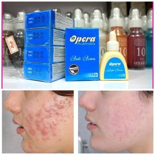 Kem Opera Australia Anti Acnes 12g