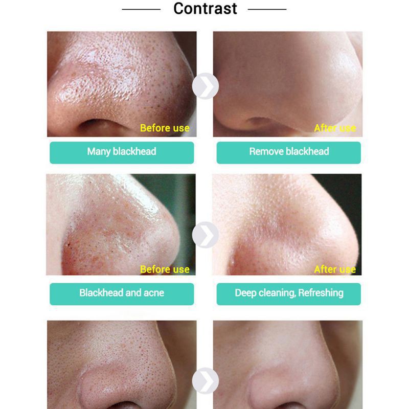Gel dán lột mụn đầu đen LANBENA