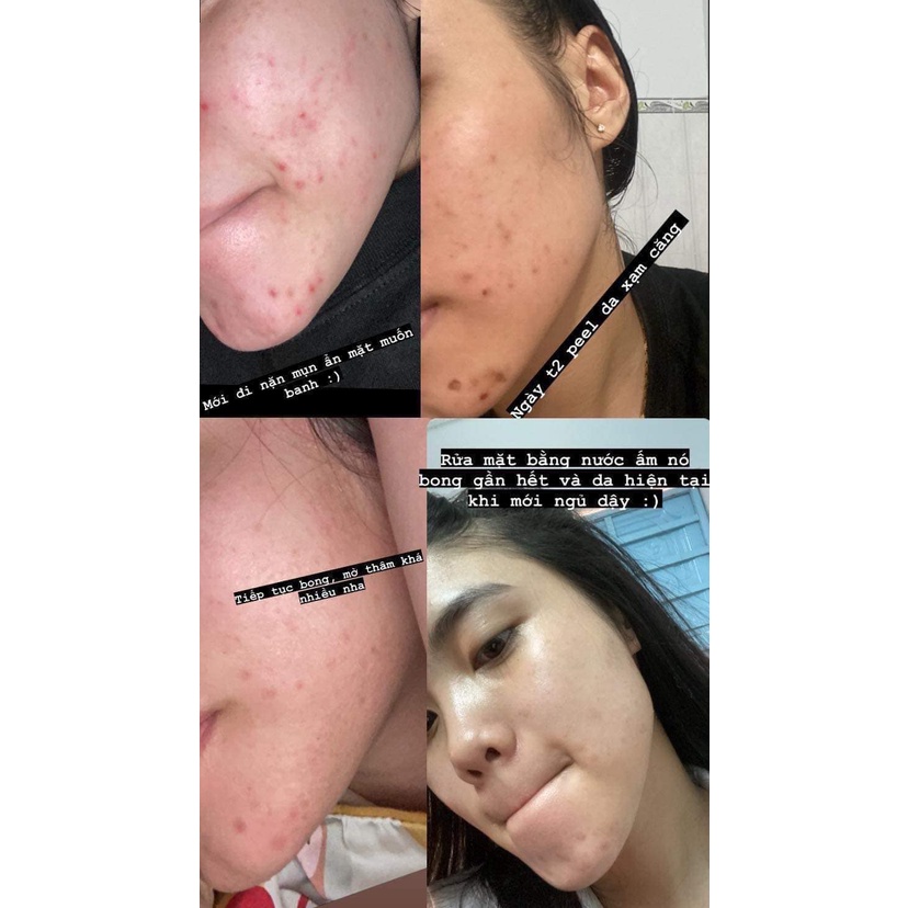 Peel Da Retinol Vi Tảo LE PEAU, Tinh Chất Tái Tạo Da Sinh Học Căng Bóng, Tặng Kèm Serum B5 Phục Hồi - 10ml