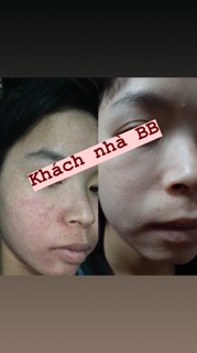 Tái tạo da BB