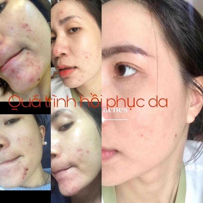 Serum Đường Đen BlackSugar Ngừa Mụn Xoá Thâm Chuẩn Hãng 5ml | BigBuy360 - bigbuy360.vn